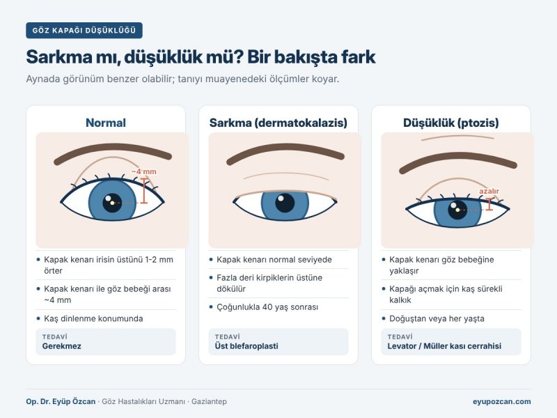Göz Kapağı Sarkması mı, Göz Kapağı Düşüklüğü (Ptozis) mü?